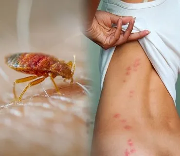 Bedbugs Treatment